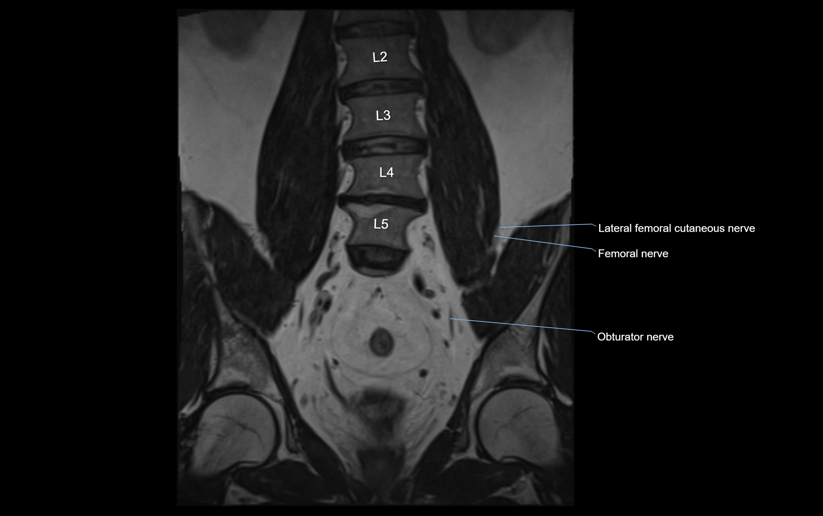 MR lumbosacral plexus cross sectional anatomy 3T  radiology  image-img-09001-00023.webp